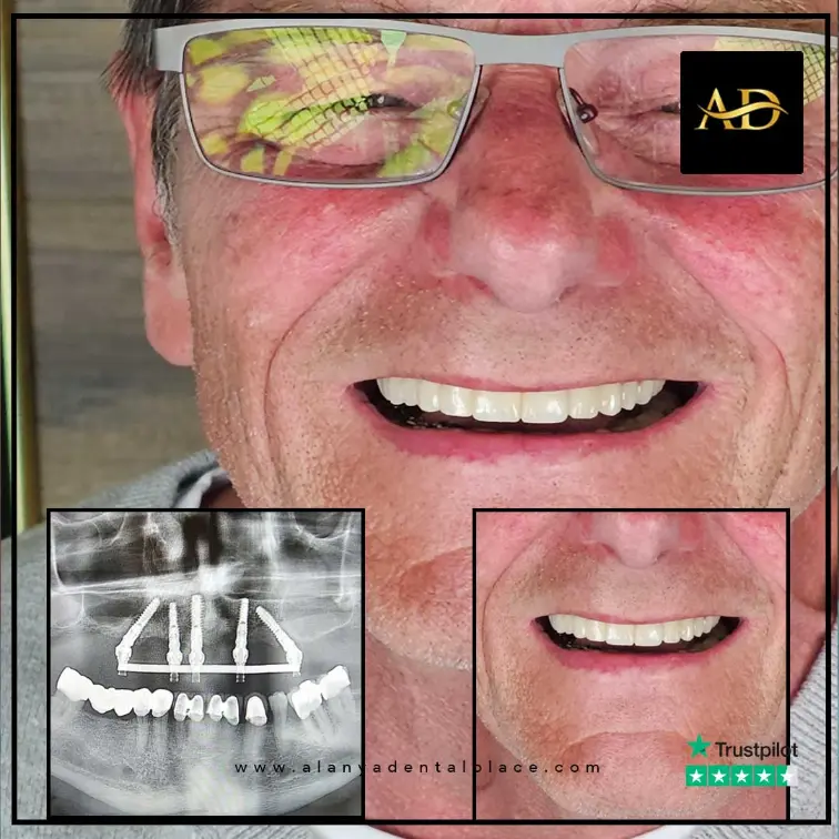 Implants dentaires All-on-4 12 2 2 3