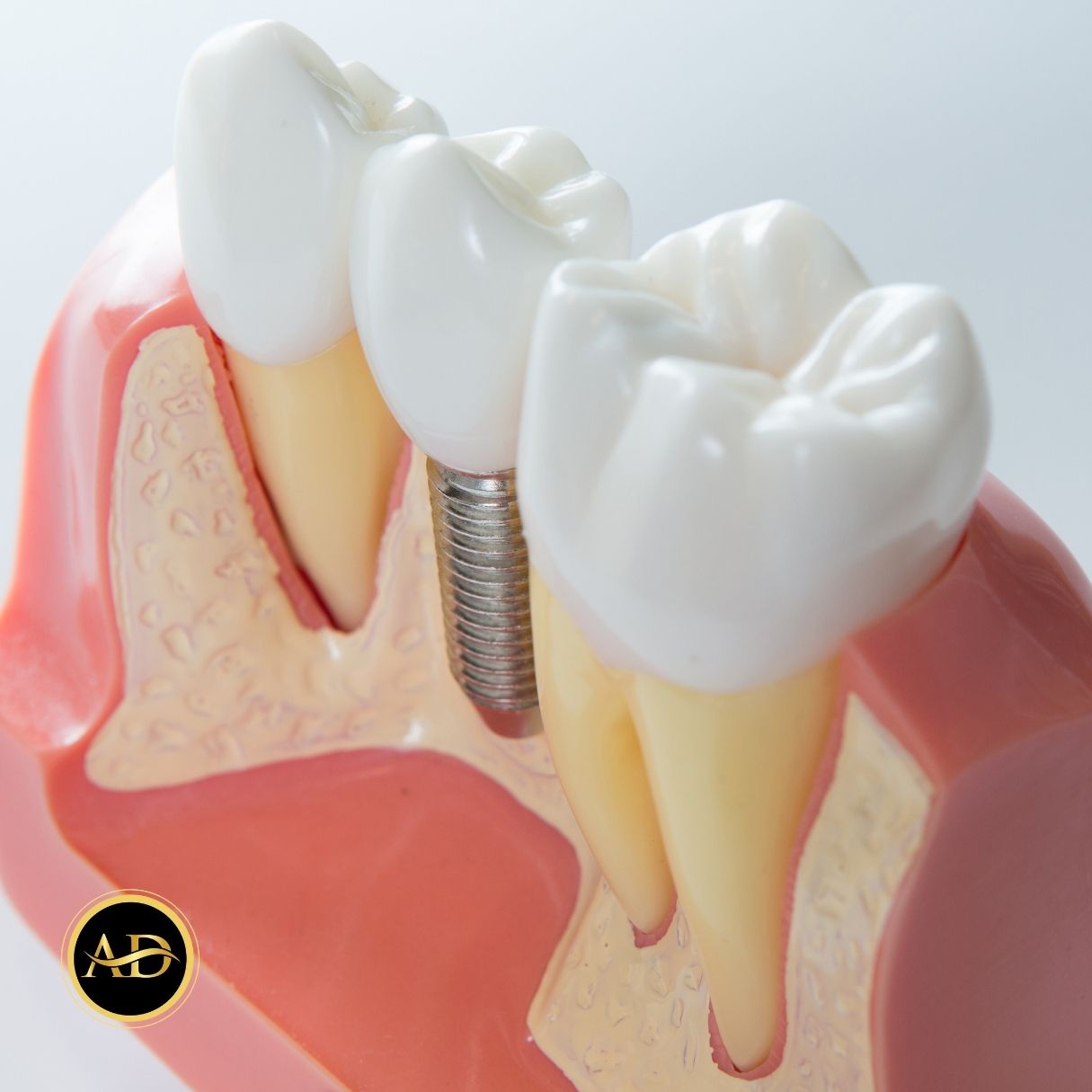 1 Günde Diş Implantı 17 bir gunde dis implanti 2