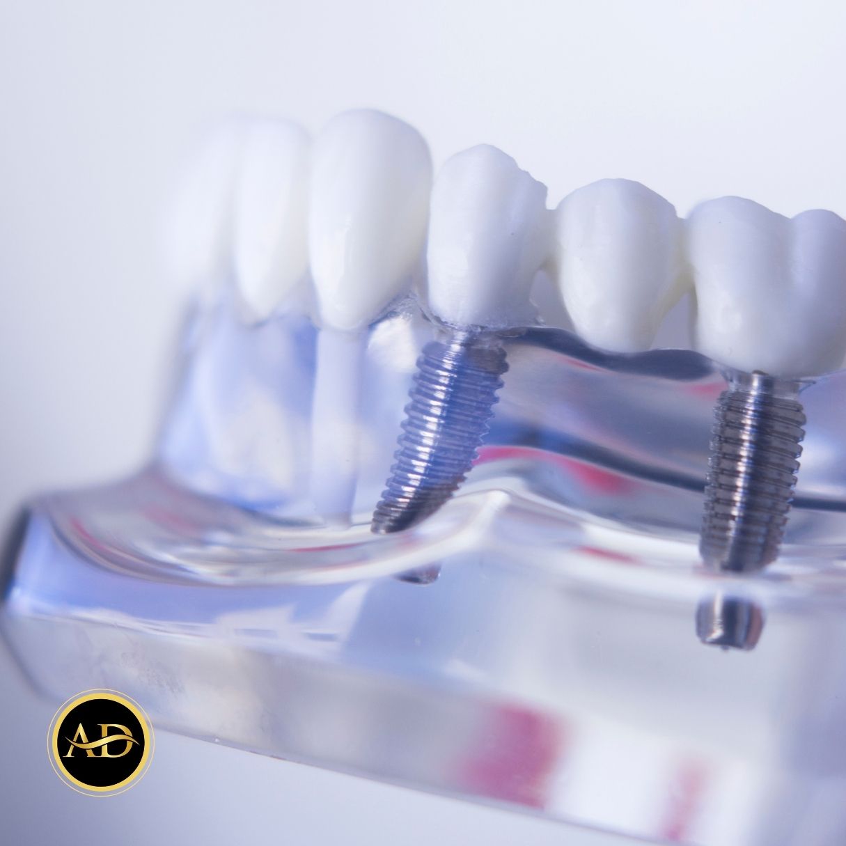 1 Günde Diş Implantı 20 hemen dis implanti