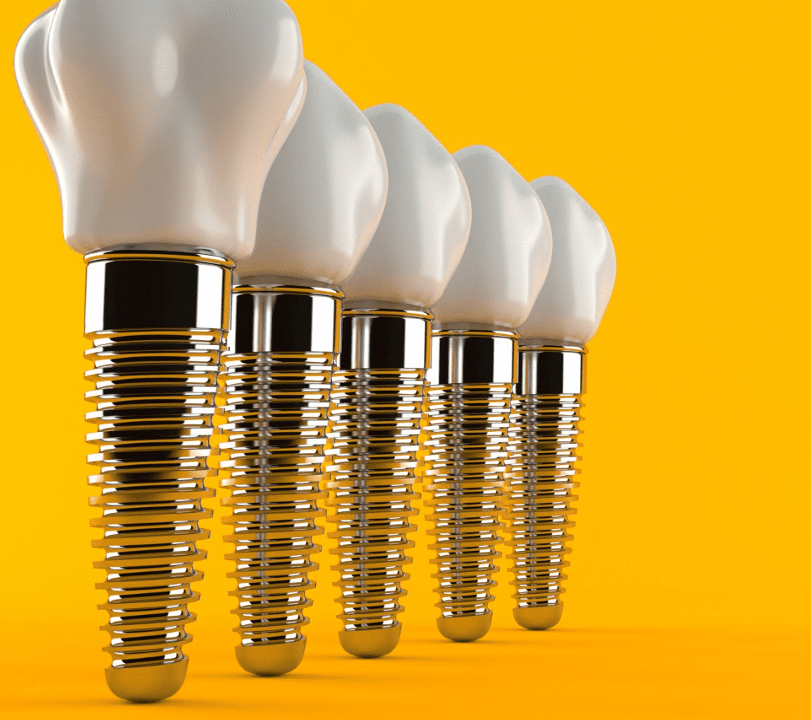 Traitement Implantaire En 1 Jour 15 implants dentaires en une journee a antalya 3