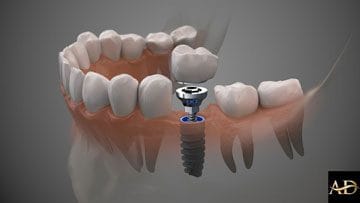 Same Day Implant 12 Image link