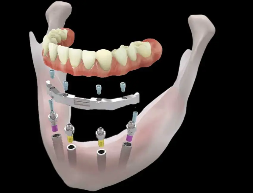 All on 4 Implants