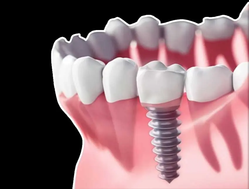 Immediate Dental Implants