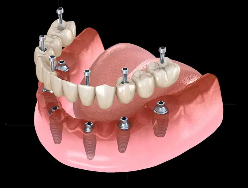 All On 6 dental implants