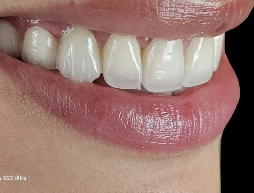 Hollywood Smile