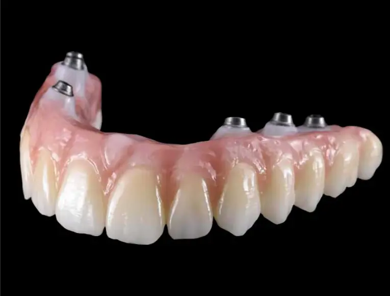 Cement-Retained Crowns on Implants