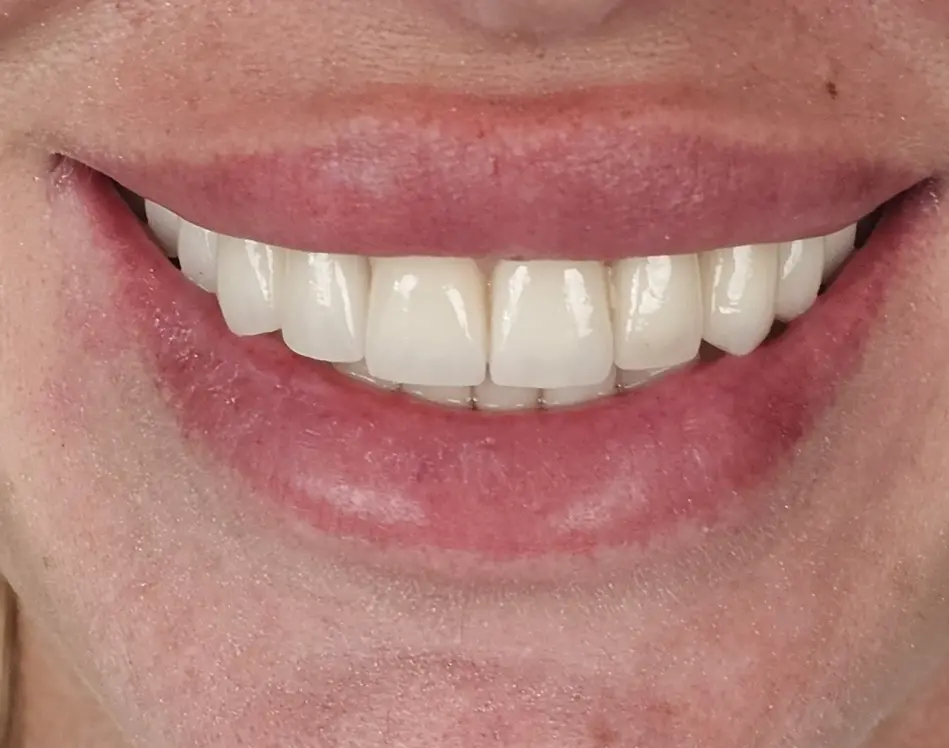 Zirconia Teeth (Zirconium Dioxide)