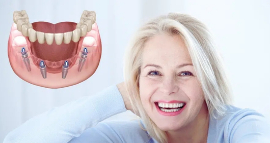 Same Day Implant 1 Same Day Dental Implant Turkey