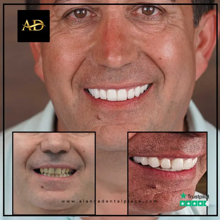 Implants dentaires All-on-4 13 5 2 3
