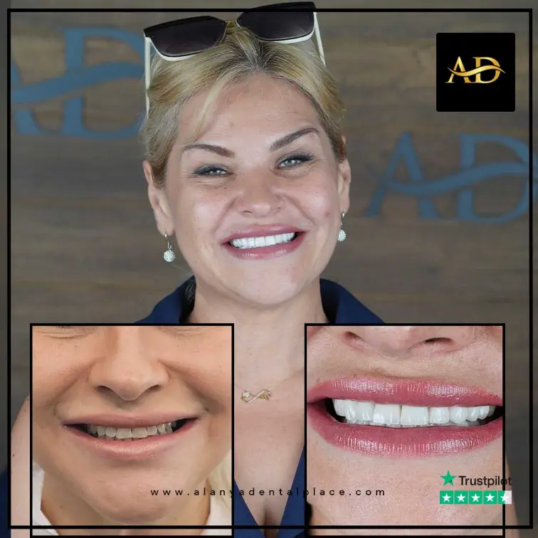 Implants dentaires All-on-4 14 6 3 3