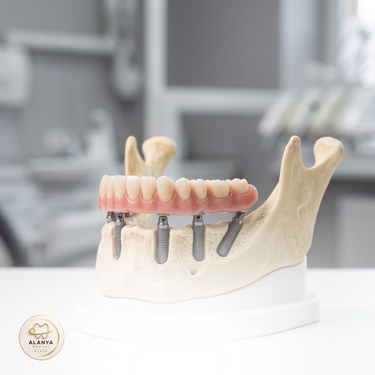 Dental Implants 36 Image link