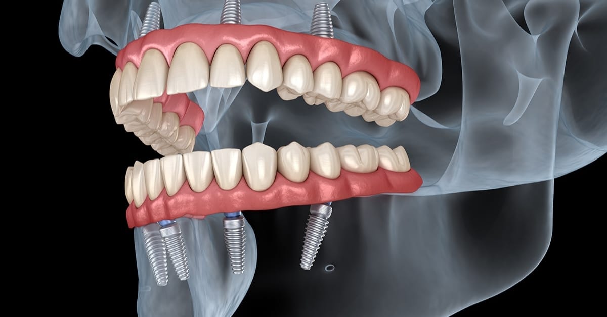 All-on-4 Dental Implants 9 All on 4 Dental Implants in Turkey 3