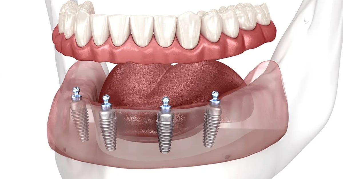 All-on-4 Dental Implants 10 All on 4 Dental Implants in Turkey 4
