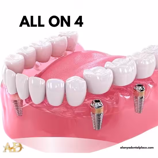 Behandlungen 2 All-on-4-Zahnimplantat