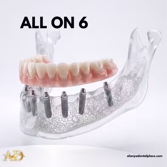 Behandlungen 3 All-on-6-Zahnimplantat