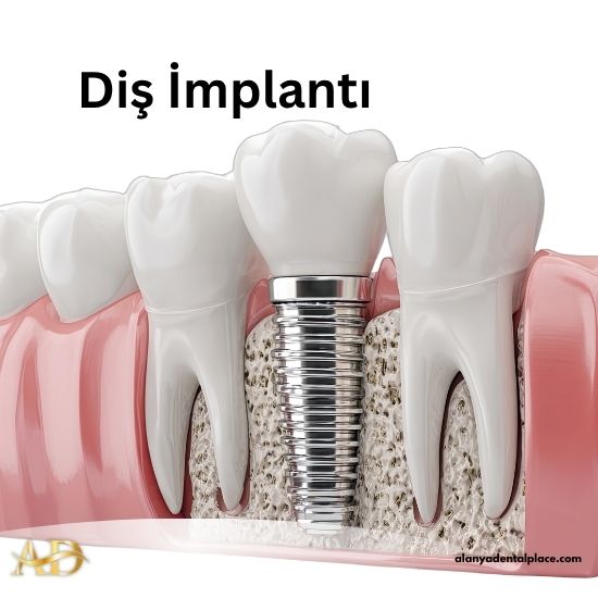 Tüm Diş Tedavilerimiz 1 Diş İmplantı