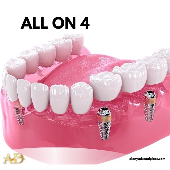 Traitements 2 Implant Dentaire All-on-4