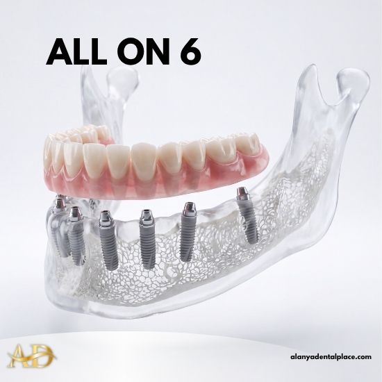 Traitements 3 Implant Dentaire All-on-6