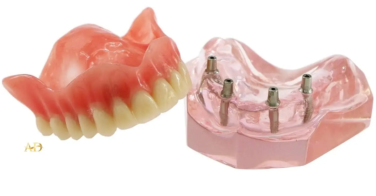 Implants dentaires All-on-4 8 Implants dentaires All on 4 en Turquie 2