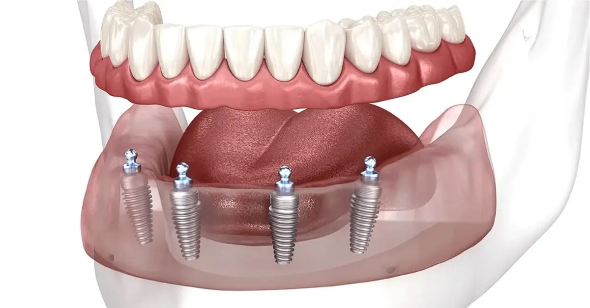 Implants dentaires All-on-4 10 Implants dentaires All on 4 en Turquie 4