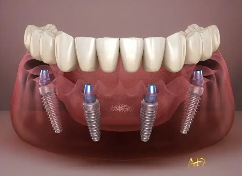 All On Four İmplant Tedavisi 10 all on 4 ustu implant