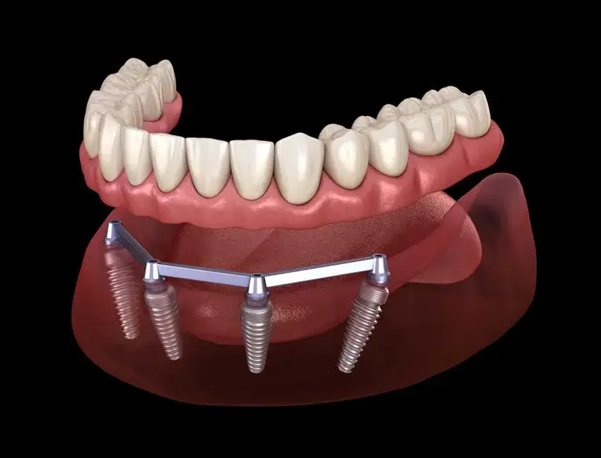 All On Four İmplant Tedavisi 9 all on four hibrit implant