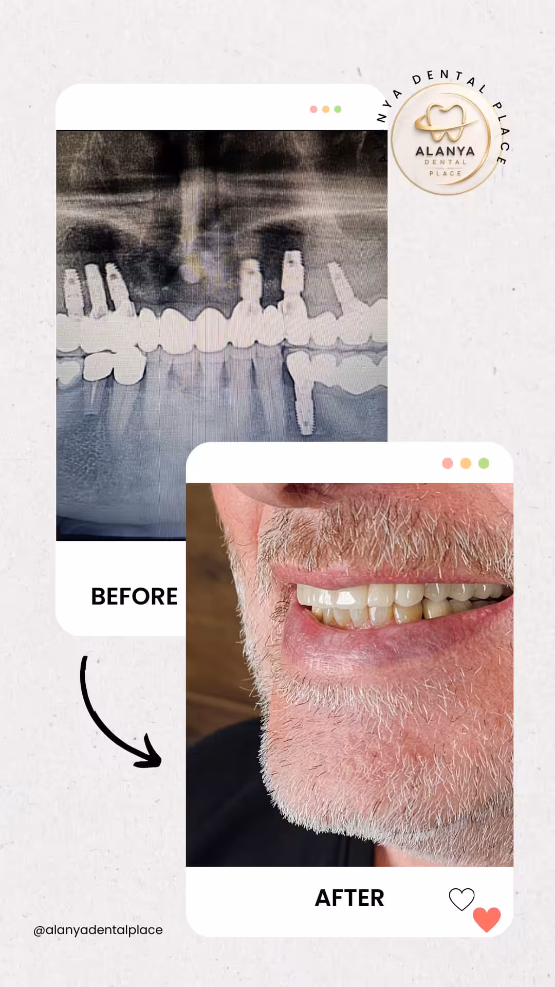 Zahnimplantate 23 before after 11