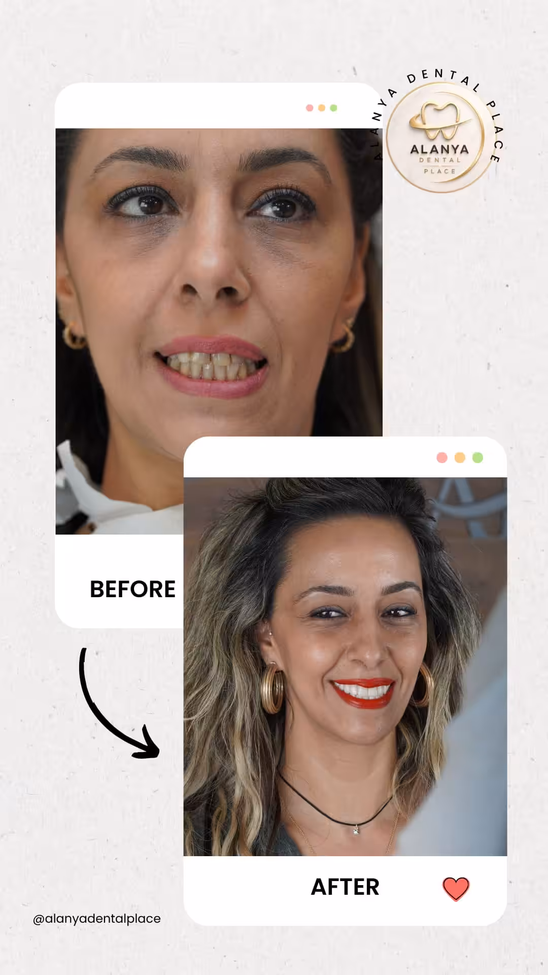 Zirkon Krone (zirkoniumdioxid-kronen) 15 before after 14