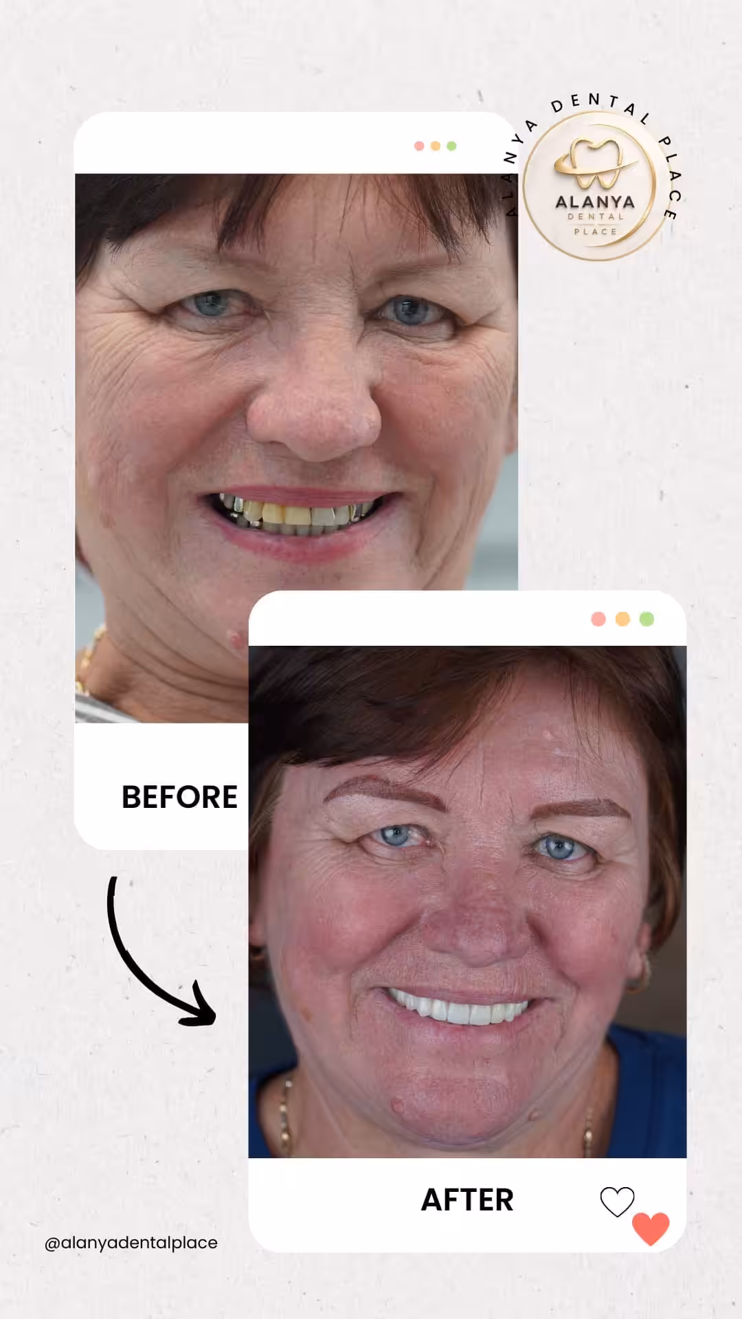 Zirkon Krone (zirkoniumdioxid-kronen) 11 before after 2