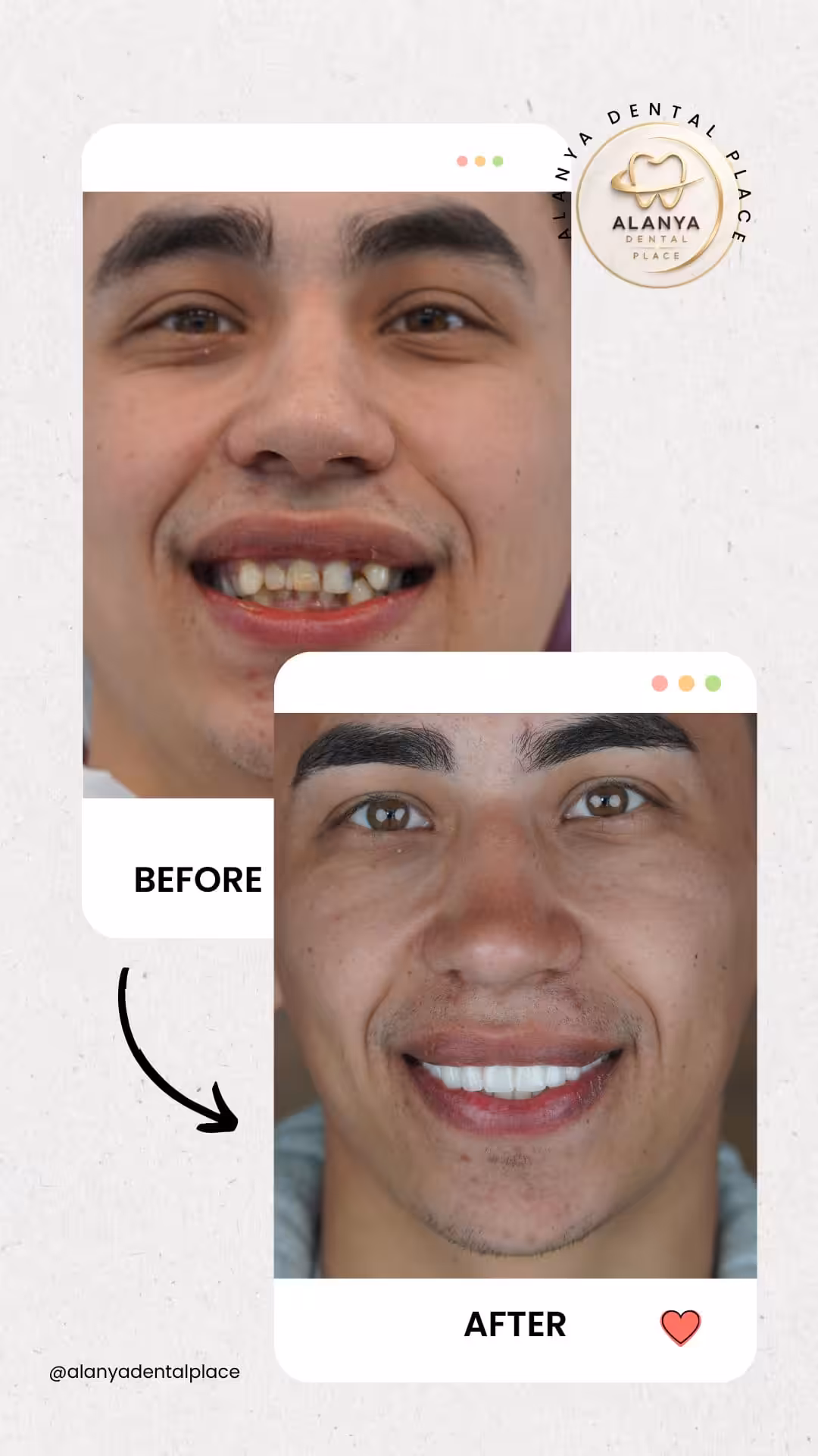 Zirkon Krone (zirkoniumdioxid-kronen) 16 before after 20
