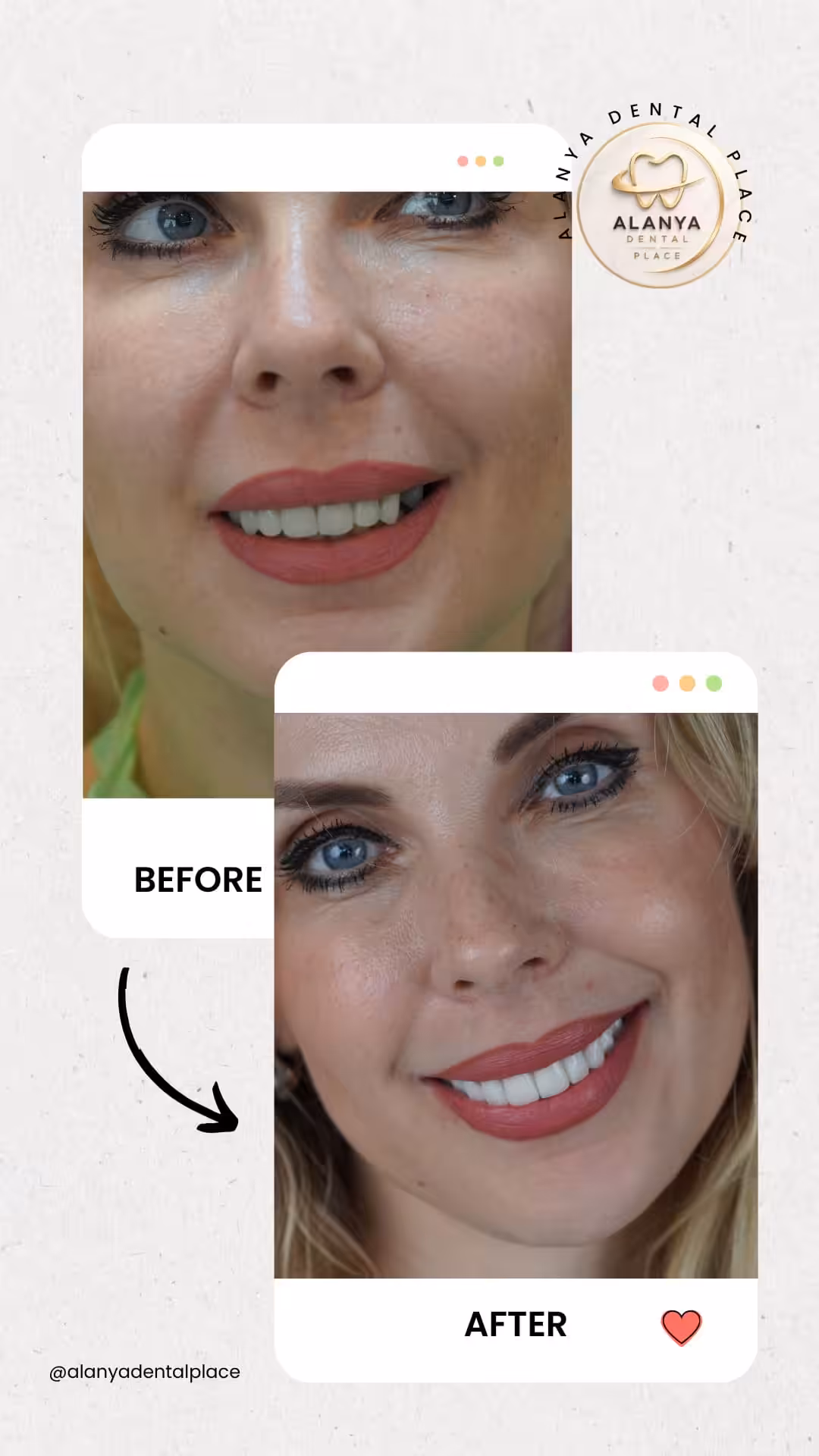 Zirkon Krone (zirkoniumdioxid-kronen) 8 before after 21