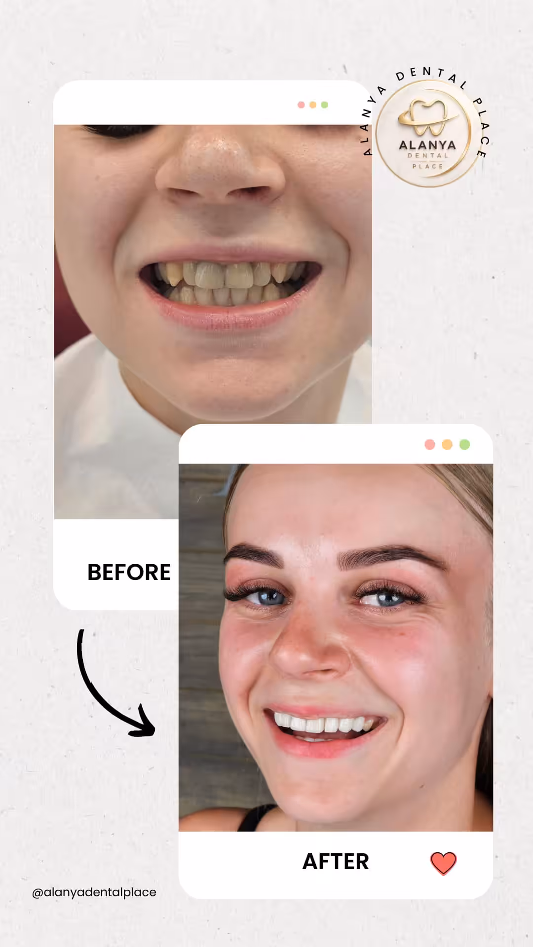 Zirkon Krone (zirkoniumdioxid-kronen) 17 before after 24