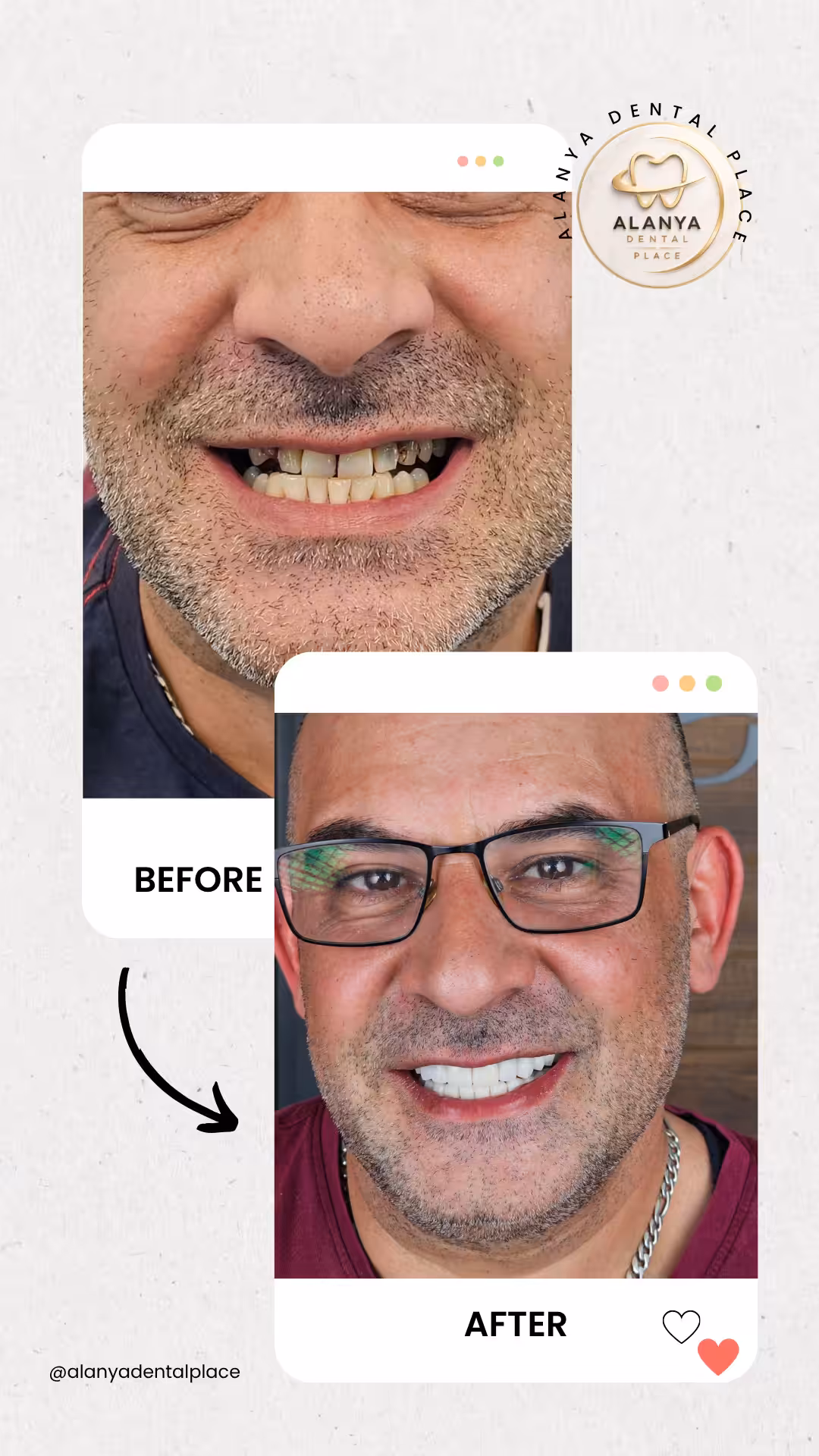 Zahnimplantate 24 before after 26