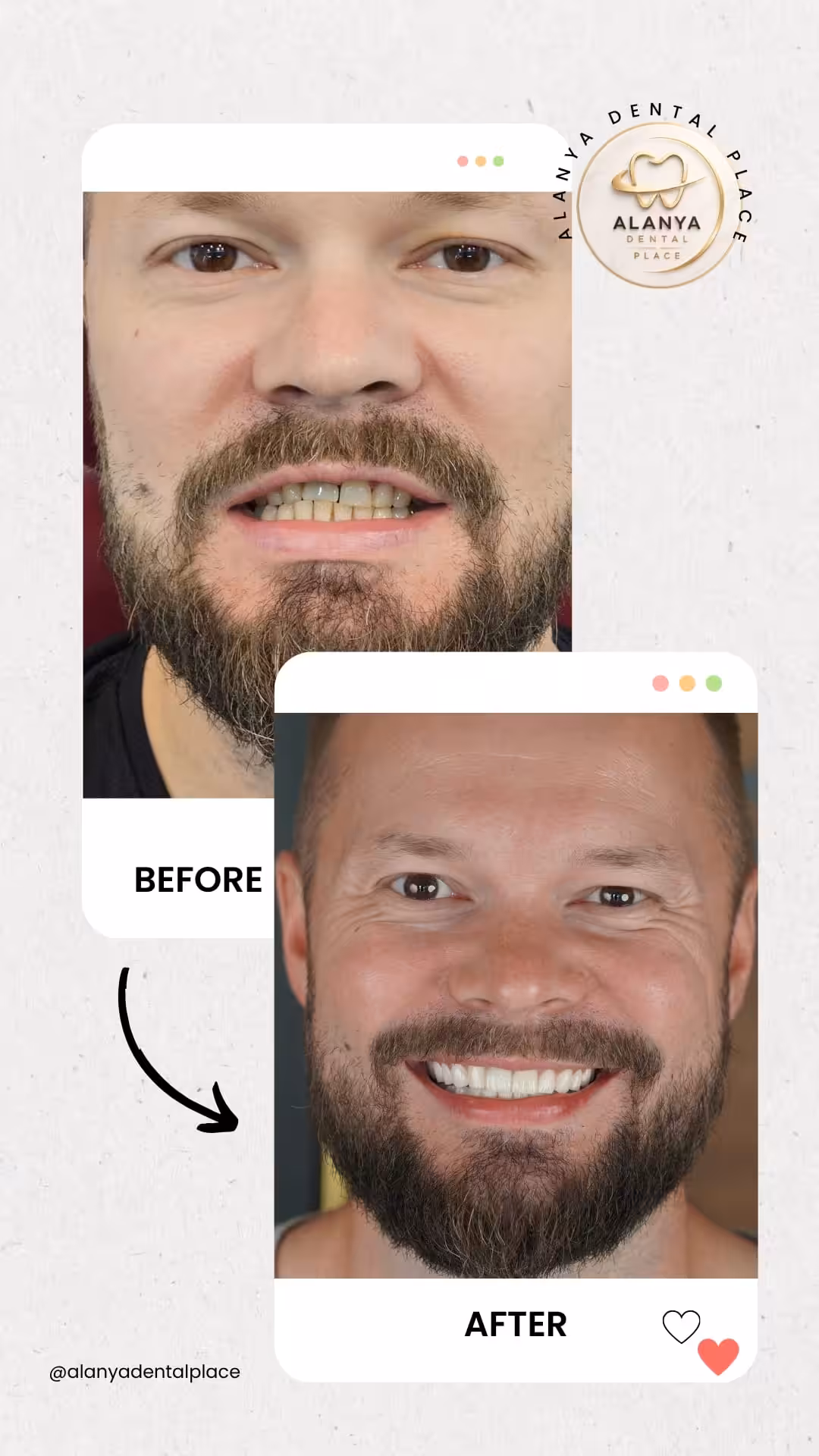 Zirkon Krone (zirkoniumdioxid-kronen) 14 before after 29