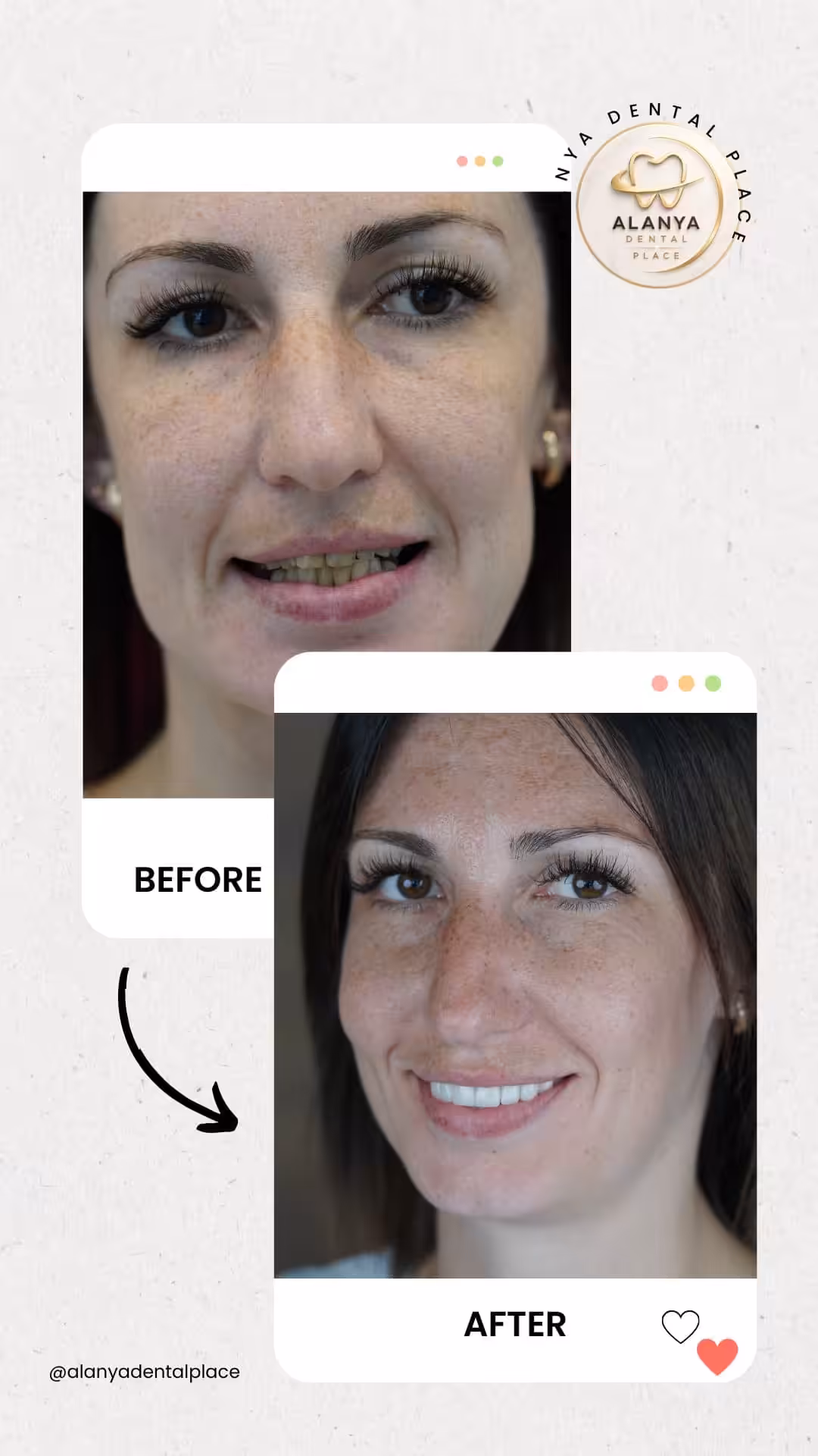 Zirkon Krone (zirkoniumdioxid-kronen) 22 before after 3