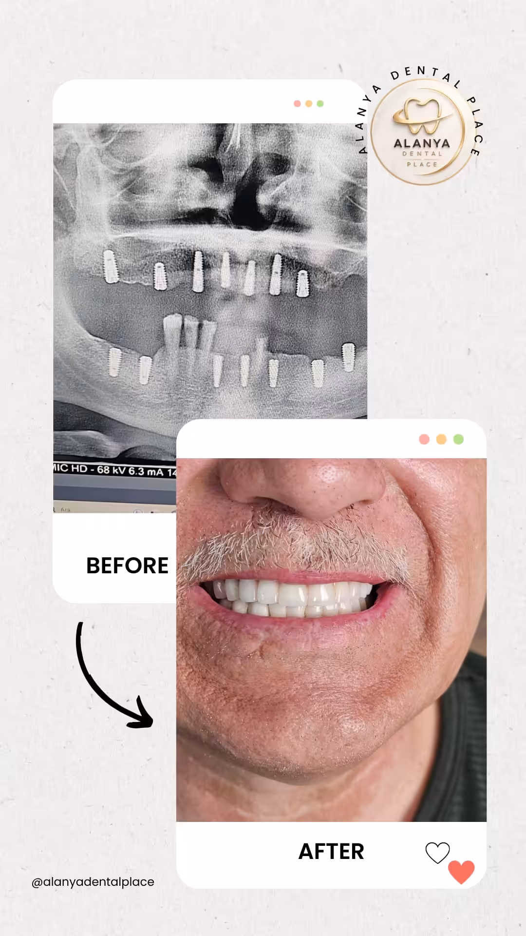 Zahnimplantate 13 before after 30