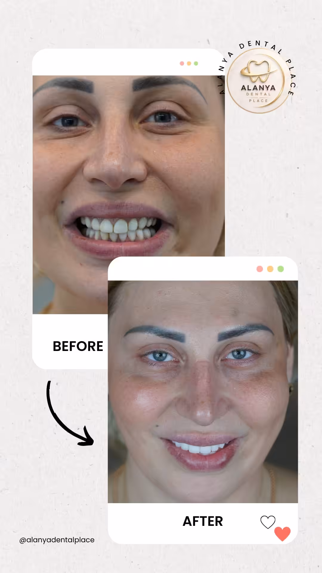 Zirkon Krone (zirkoniumdioxid-kronen) 19 before after 32