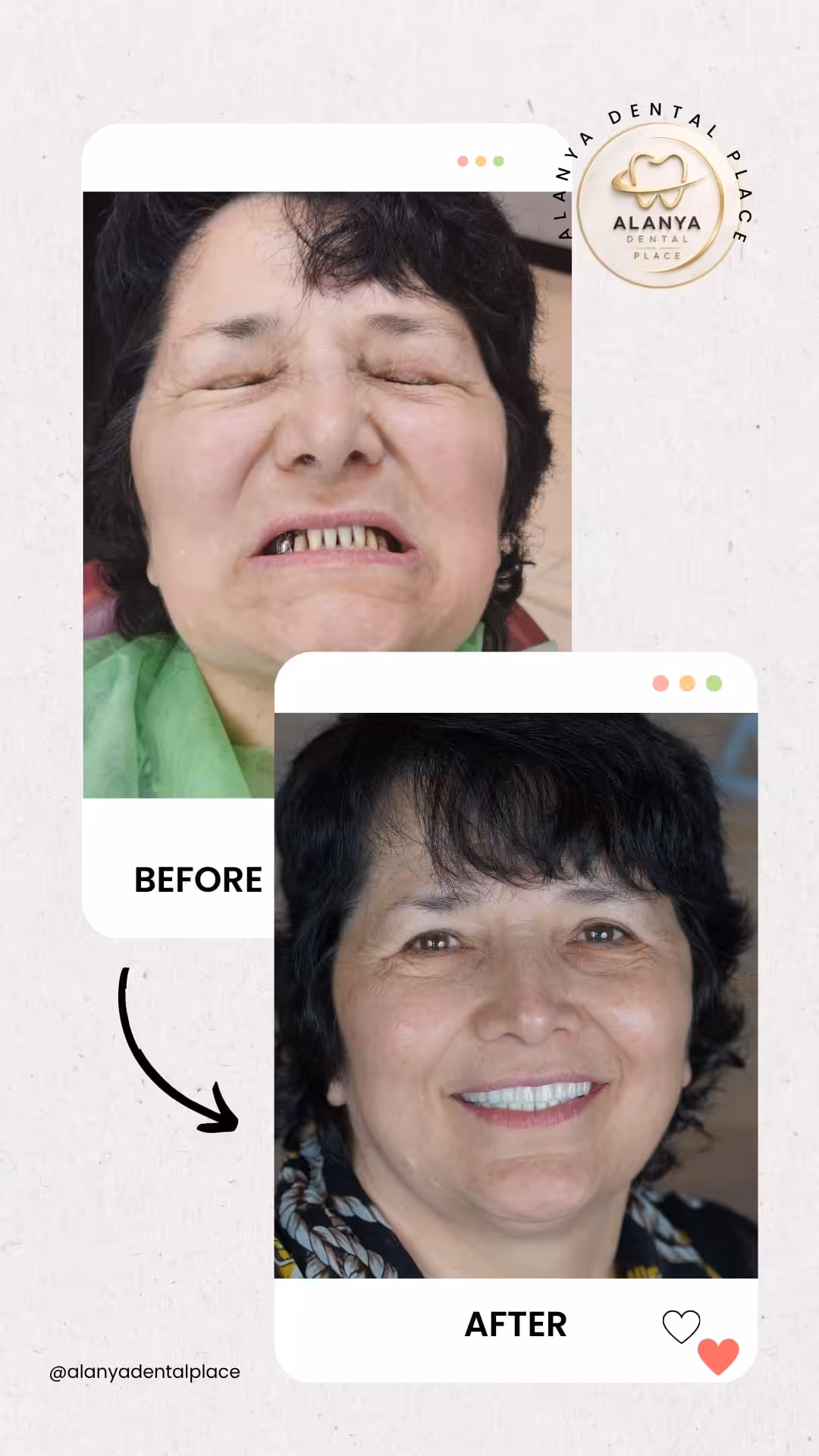 Zahnimplantate 18 before after 33