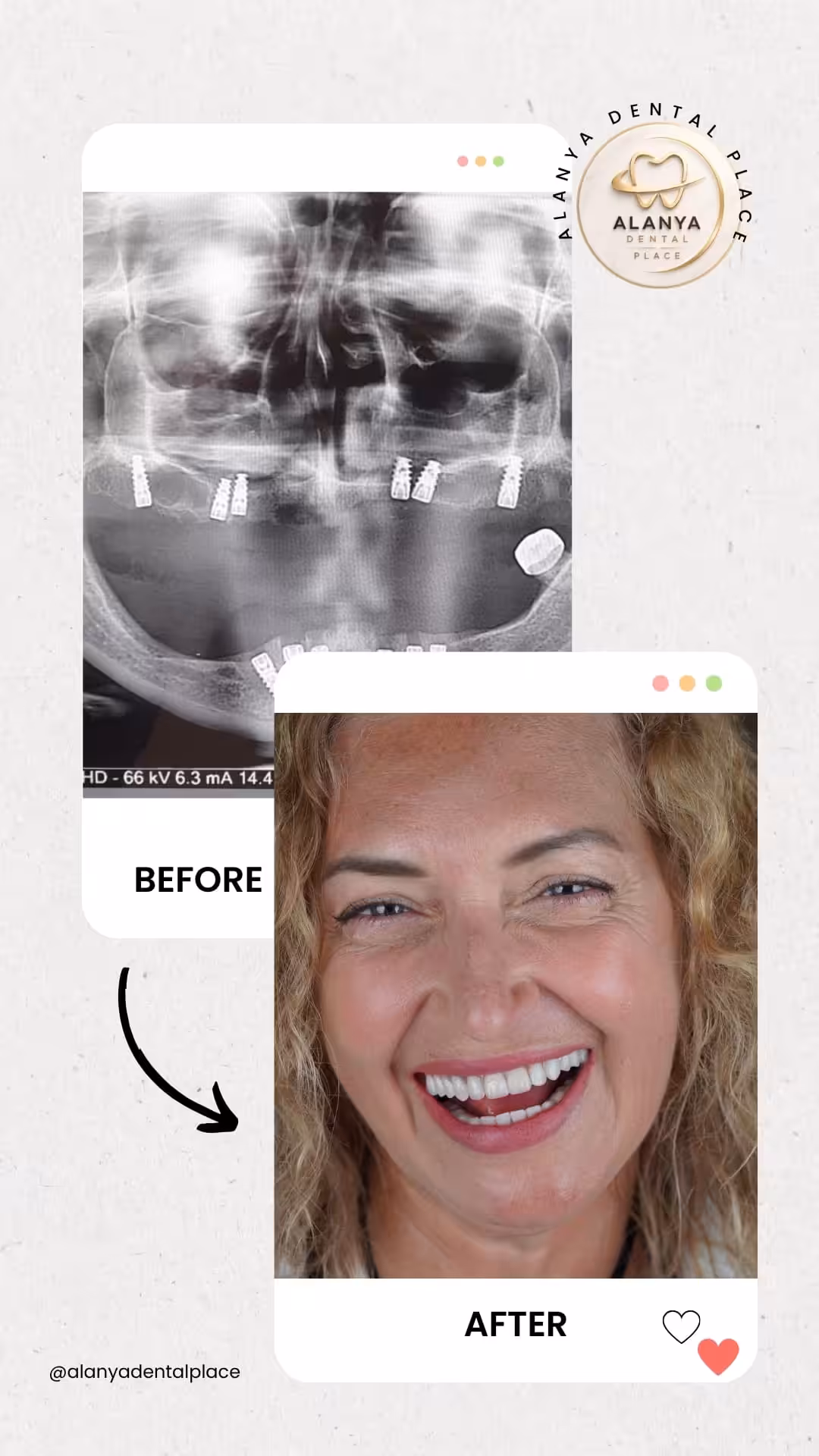 Zahnimplantate 14 before after 34