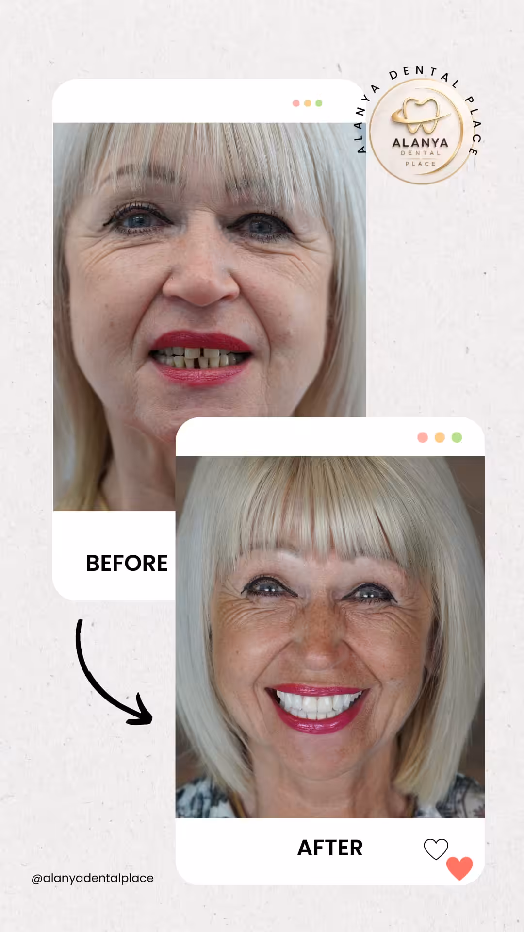Zirkon Krone (zirkoniumdioxid-kronen) 20 before after 36