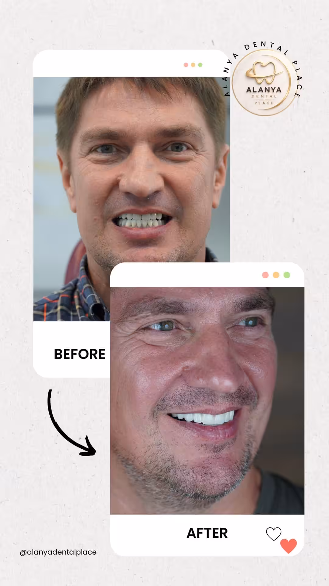 Zirkon Krone (zirkoniumdioxid-kronen) 23 before after 4
