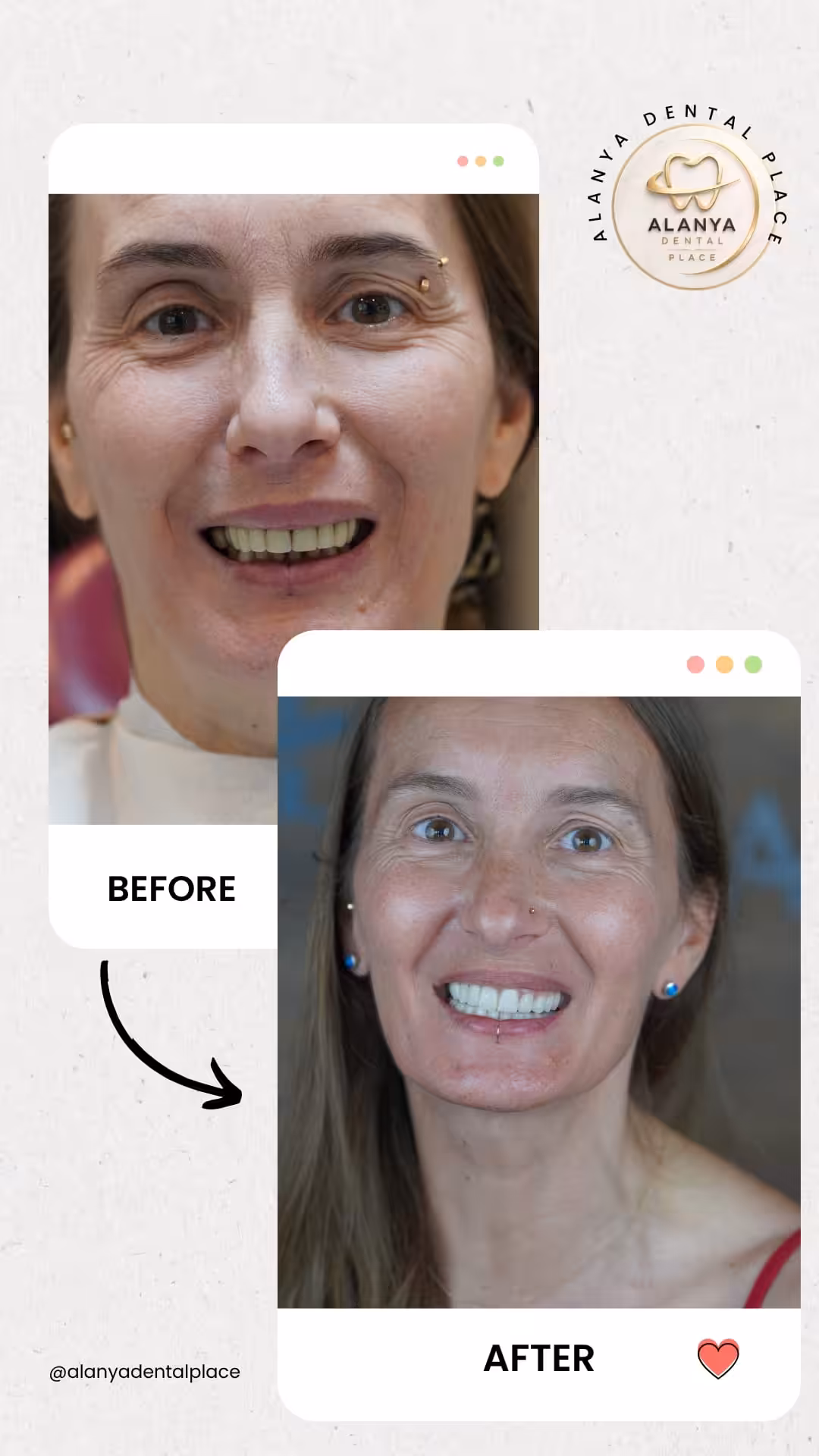 Zirkon Krone (zirkoniumdioxid-kronen) 21 before after 42 1