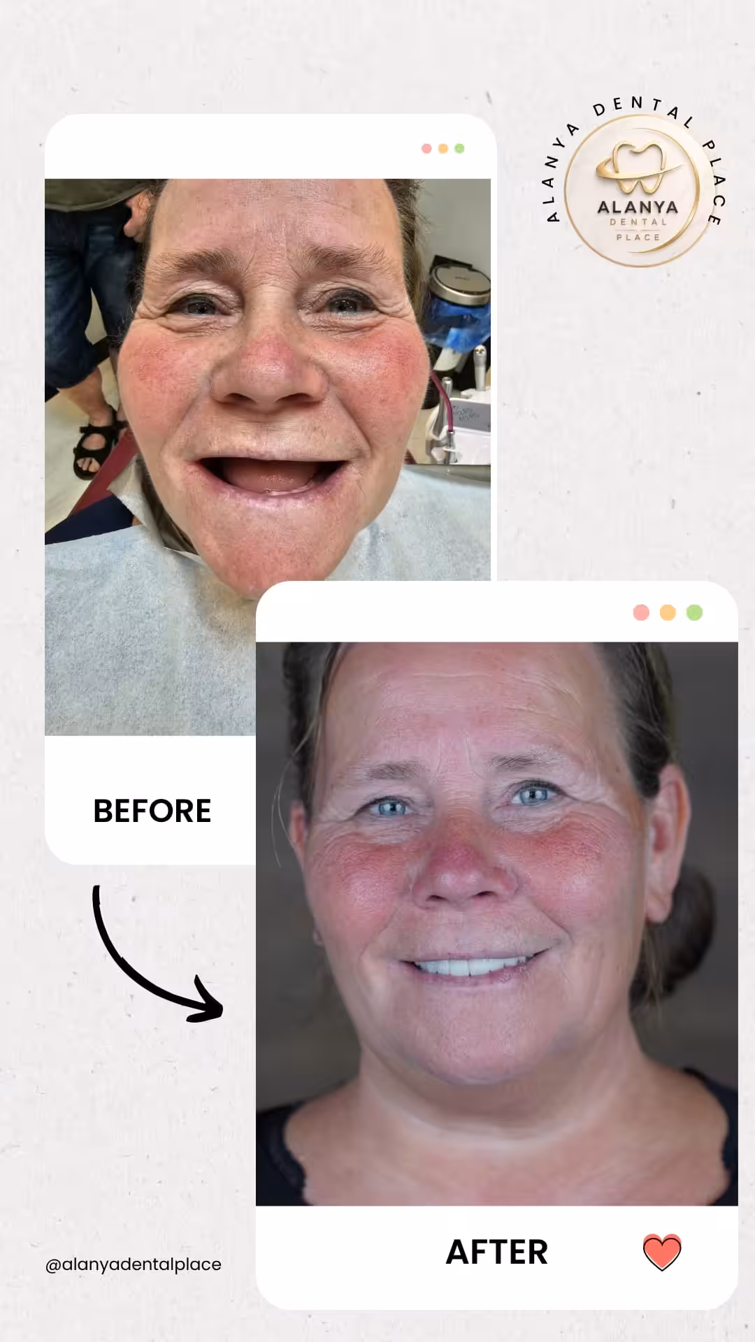Zahnimplantate 16 before after 42