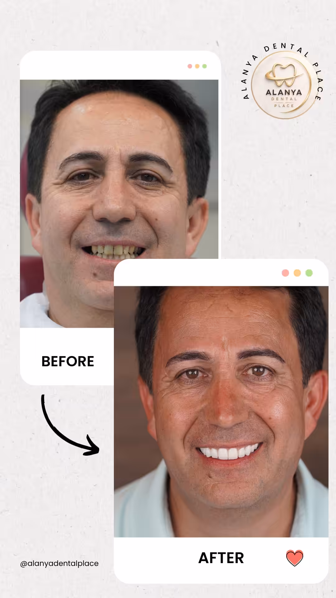 Zirkon Krone (zirkoniumdioxid-kronen) 13 before after 44