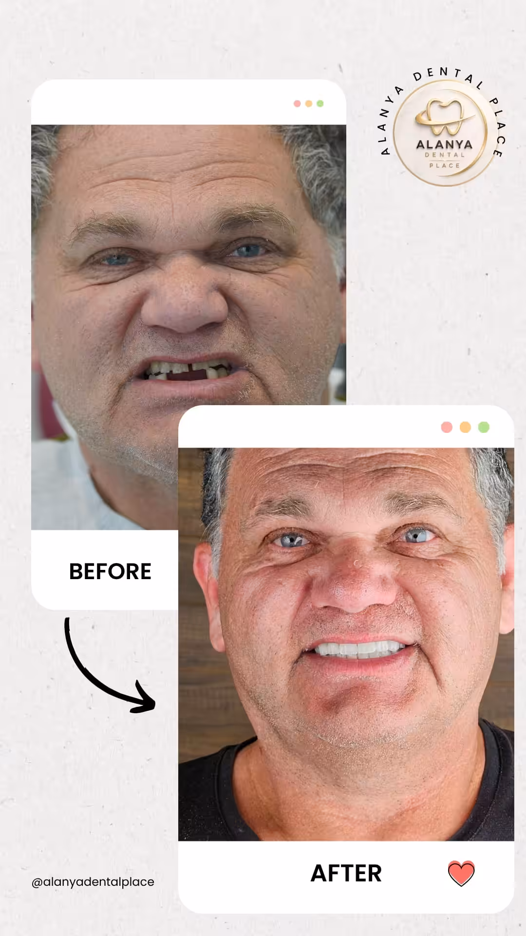 Zahnimplantate 19 before after 45
