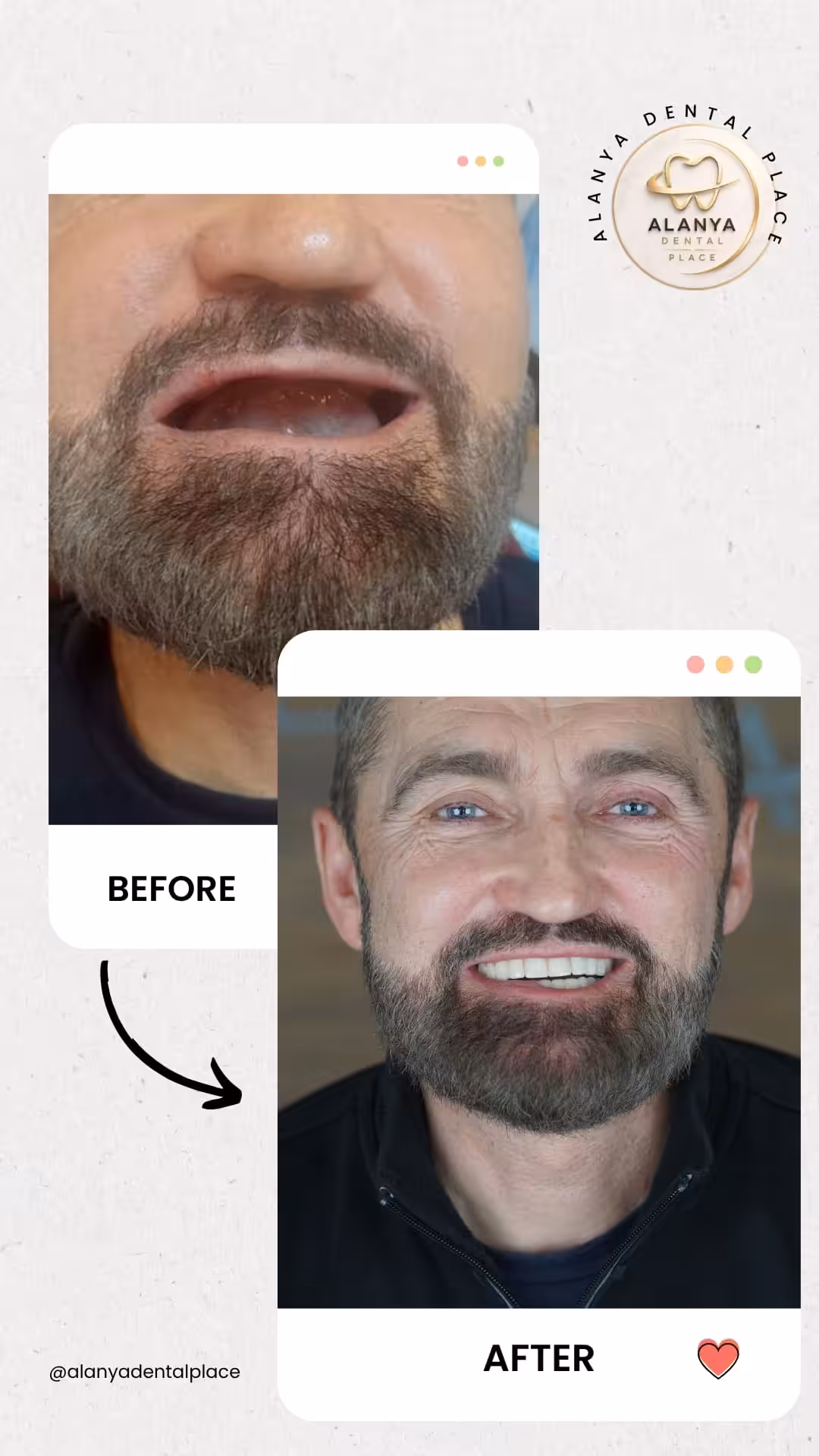 Zahnimplantate 20 before after 47