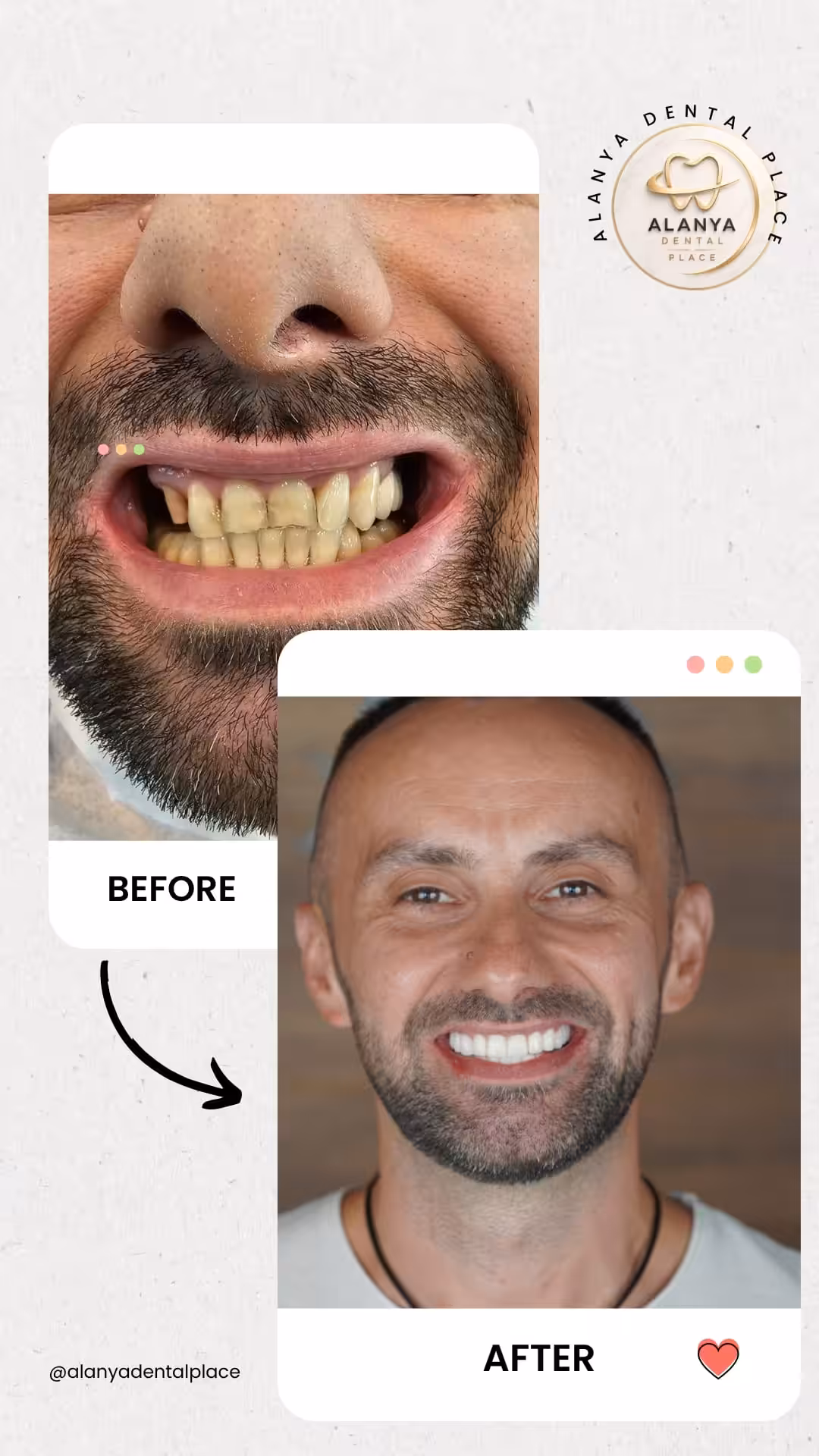 Zirkon Krone (zirkoniumdioxid-kronen) 10 before after 49
