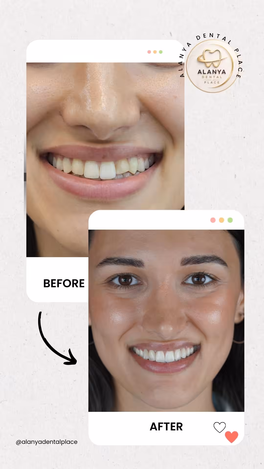 Zirkon Krone (zirkoniumdioxid-kronen) 5 before after 51