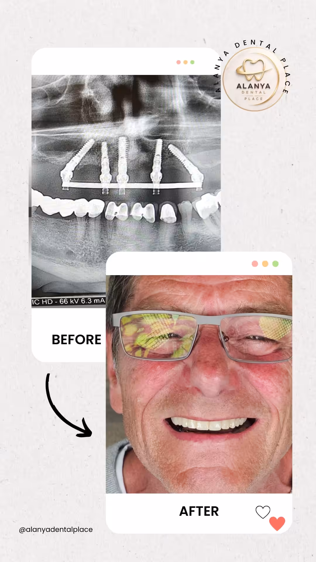 Zahnimplantate 21 before after 52