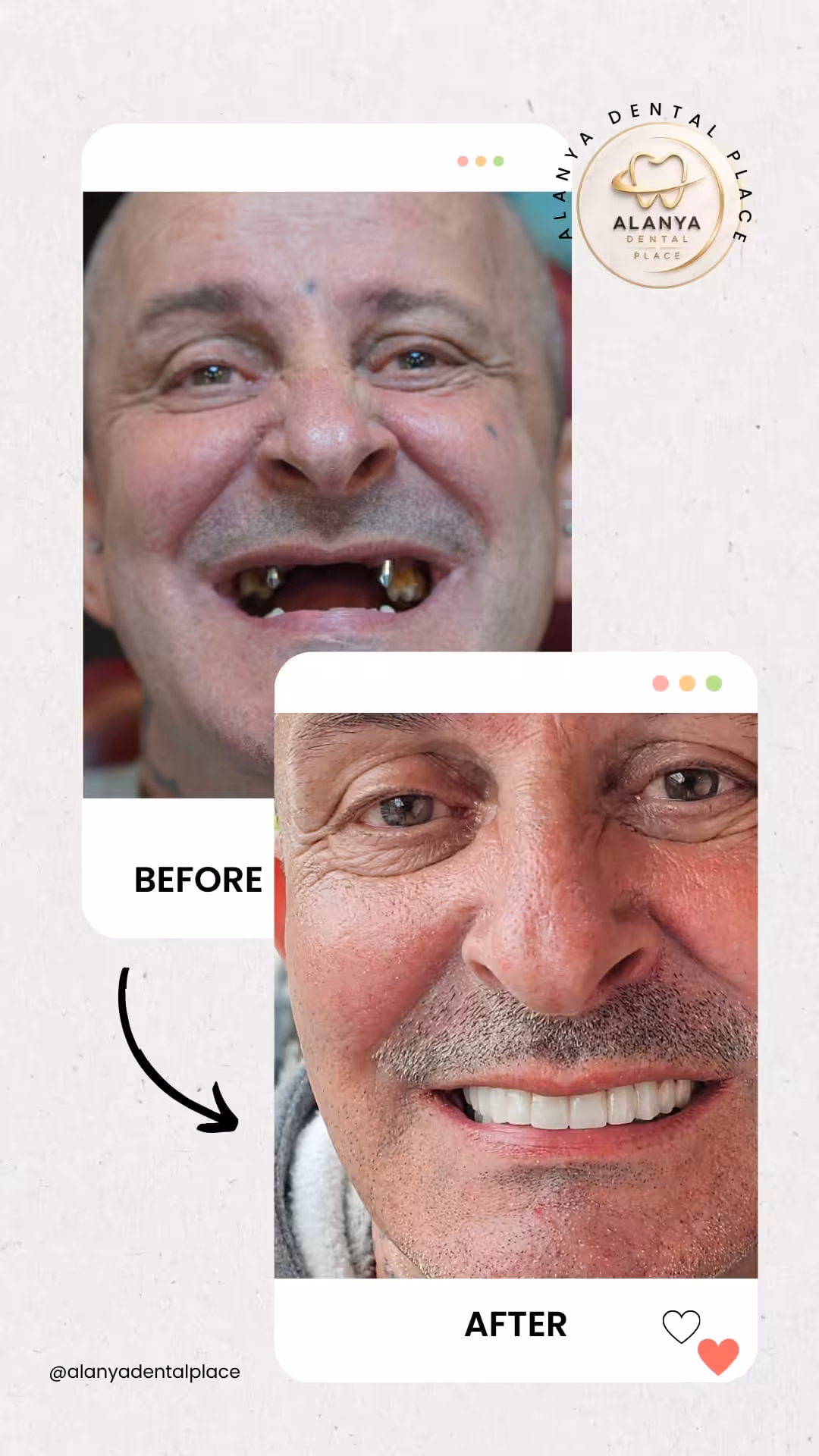 Zahnimplantate 11 before after 54